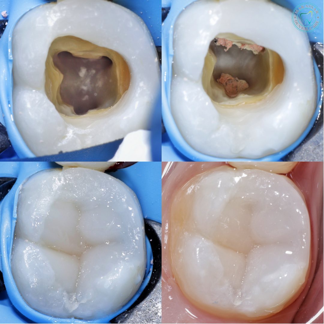 root canal treatment