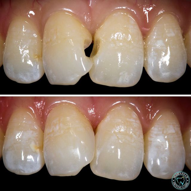 tooth-coloured fillings